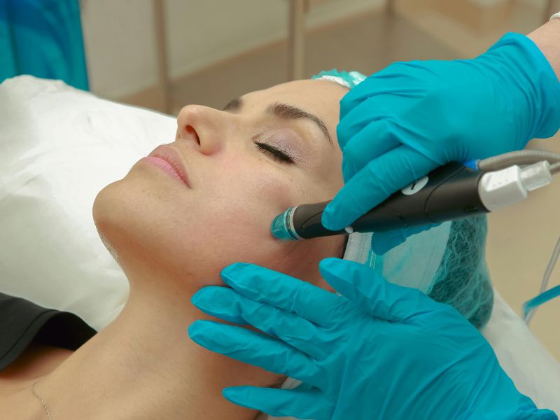 10 Beneficios del Hidrodermoabrasión en Fuengirola para una Piel Radiante