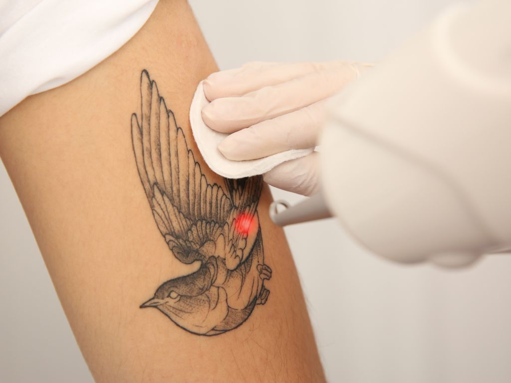 Eliminación de tatuajes en Fuengirola